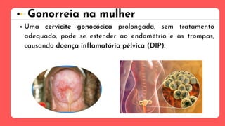 Gonorreia na mulher
Uma cervicite gonocócica prolongada, sem tratamento
adequado, pode se estender ao endométrio e às trompas,
causando doença inflamatória pélvica (DIP).
 