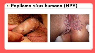 Papiloma vírus humano (HPV)
 