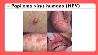 Papiloma vírus humano (HPV)
 