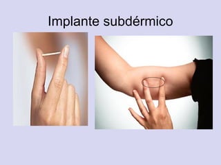 Implante subdérmico
 