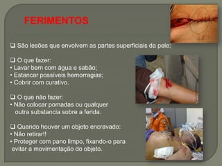 FERIMENTOS

 São lesões que envolvem as partes superficiais da pele;

 O que fazer:
• Lavar bem com água e sabão;
• Estancar possíveis hemorragias;
• Cobrir com curativo.

 O que não fazer:
• Não colocar pomadas ou qualquer
  outra substancia sobre a ferida.

 Quando houver um objeto encravado:
• Não retirar!!
• Proteger com pano limpo, fixando-o para
 evitar a movimentação do objeto.
 