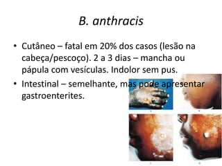 B. anthracisCutâneo – fatal em 20% dos casos (lesão na cabeça/pescoço). 2 a 3 dias – mancha ou pápula com vesículas. Indolor sem pus.Intestinal – semelhante, mas pode apresentar gastroenterites.