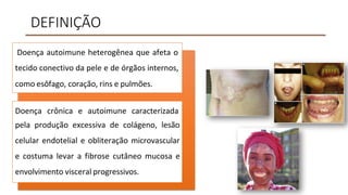 DEFINIÇÃO
Doença autoimune heterogênea que afeta o
tecido conectivo da pele e de órgãos internos,
como esôfago, coração, rins e pulmões.
Doença crônica e autoimune caracterizada
pela produção excessiva de colágeno, lesão
celular endotelial e obliteração microvascular
e costuma levar a fibrose cutâneo mucosa e
envolvimento visceral progressivos.
 
