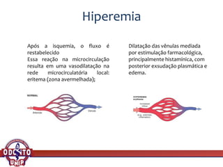 Hiperemia
Após a isquemia, o fluxo é
restabelecido
Essa reação na microcirculação
resulta em uma vasodilatação na
rede microcirculatória local:
eritema (zona avermelhada);
Dilatação das vênulas mediada
por estimulação farmacológica,
principalmente histamínica, com
posterior exsudação plasmática e
edema.
 