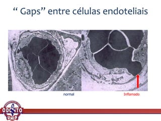 “ Gaps” entre células endoteliais
normal Inflamado
 