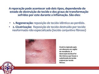 A reparação pode acontecer sob dois tipos, dependendo do
estado de destruição do tecido e dos graus de transformação
sofridos por este durante a inflamação. São eles:
• 1. Regeneração: reposição de tecido idêntico ao perdido.
• 2. Cicatrização: Reposição de tecido destruído por tecido
neoformado não especializado (tecido conjuntivo fibroso)
Cicatriz originada após
um abscesso em região
de mandíbula. A
destruição tecidual foi
tão intensa que houve a
substituição do tecido
original por tecido
fibroso.
 