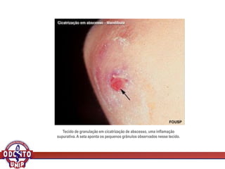 Tecido de granulação em cicatrização de abscesso, uma inflamação
supurativa. A seta aponta os pequenos grânulos observados nesse tecido.
 