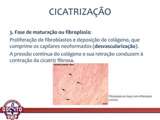 CICATRIZAÇÃO
3. Fase de maturação ou fibroplasia:
Proliferação de fibroblastos e deposição de colágeno, que
comprime os capilares neoformados (desvascularização).
A pressão contínua do colágeno e sua retração conduzem à
contração da cicatriz fibrosa.
Fibroplasia em baço com inflamação
crônica.
 