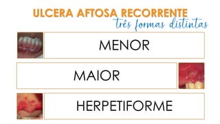 ULCERA AFTOSA RECORRENTE
MENOR
MAIOR
HERPETIFORME
três formas distintas
 