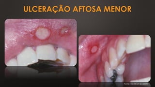 ULCERAÇÃO AFTOSA MENOR
Fonte: Neville et al. (2009)
 
