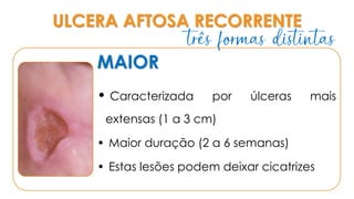 ULCERA AFTOSA RECORRENTE
MAIOR
• Caracterizada por úlceras mais
extensas (1 a 3 cm)
• Maior duração (2 a 6 semanas)
• Estas lesões podem deixar cicatrizes
três formas distintas
 