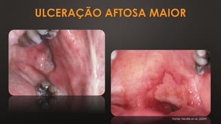 ULCERAÇÃO AFTOSA MAIOR
Fonte: Neville et al. (2009)
 