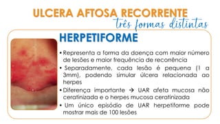 ULCERA AFTOSA RECORRENTE
HERPETIFORME
•Representa a forma da doença com maior número
de lesões e maior frequência de recorrência
• Separadamente, cada lesão é pequena (1 a
3mm), podendo simular úlcera relacionada ao
herpes
•Diferença importante → UAR afeta mucosa não
ceratinizada e o herpes mucosa ceratinizada
• Um único episódio de UAR herpetiforme pode
mostrar mais de 100 lesões
três formas distintas
 