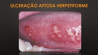 ULCERAÇÃO AFTOSA HERPETIFORME
Fonte: Neville et al. (2009)
 