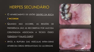 HERPES SECUNDÁRIO
• O APARECIMENTO DE LESÕES DENTRO DA BOCA
É INCOMUM
• QUANDO ISSO OCORRE, AS REGIÕES DE
PREFERÊNCIA SÃO AS RECOBERTAS POR MUCOSA
CERATINIZADA ASSOCIADA A TECIDO ÓSSEO
(GENGIVA E PALATO DURO)
• APÓS A RUPTURA DAS VESÍCULAS INTRA-ORAIS
APARECEM ÁREAS ERITEMATOSAS OU ULCERADAS
Fonte: Neville et al. (2009)
 