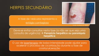 HERPES SECUNDÁRIO
A fase de vesículas representa o
estágio contagioso
Deve-se evitar consultas nesta fase (a não ser que seja uma
consulta de urgência) → Panarício herpético ou paroníquia
herpética
O uso de laserterapia de baixa intensidade pode ajudar para
acelerar o processo de cicatrização durante a fase de
crosta/ulceração
Fonte: Neville et al. (2009)
 