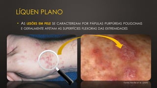 LÍQUEN PLANO
• AS LESÕES EM PELE SE CARACTERIZAM POR PÁPULAS PURPÚREAS POLIGONAIS
E GERALMENTE AFETAM AS SUPERFÍCIES FLEXORAS DAS EXTREMIDADES
Fonte: Neville et al. (2009)
 