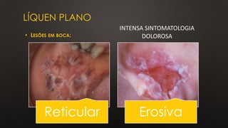 LÍQUEN PLANO
• LESÕES EM BOCA:
Reticular Erosiva
INTENSA SINTOMATOLOGIA
DOLOROSA
 