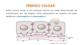 PÊNFIGO VULGAR
• Bolhas ocorrem devido a uma produção anormal, por razões desconhecidas, de
autoanticorpos que são dirigidos contra glicoproteínas de superfície da célula
epidérmica, a desmogleína 3 e a desmogleína 1
Regezi, Sciubba, Jordan (2013)
 