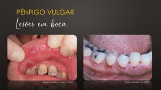 PÊNFIGO VULGAR
Lesões em boca
Regezi, Sciubba, Jordan (2013) Fonte: Neville et al. (2009)
 