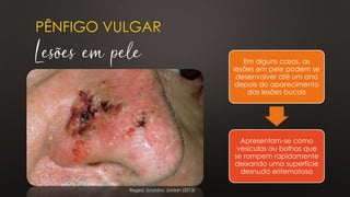 PÊNFIGO VULGAR
Lesões em pele
Regezi, Sciubba, Jordan (2013)
Em alguns casos, as
lesões em pele podem se
desenvolver até um ano
depois do aparecimento
das lesões bucais
Apresentam-se como
vesículas ou bolhas que
se rompem rapidamente
deixando uma superfície
desnuda eritematosa
 