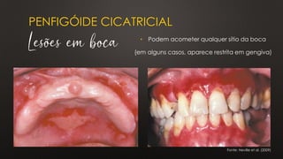 PENFIGÓIDE CICATRICIAL
Lesões em boca
Fonte: Neville et al. (2009)
• Podem acometer qualquer sítio da boca
(em alguns casos, aparece restrita em gengiva)
 