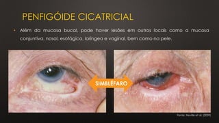 PENFIGÓIDE CICATRICIAL
Fonte: Neville et al. (2009)
• Além da mucosa bucal, pode haver lesões em outros locais como a mucosa
conjuntiva, nasal, esofágica, laríngea e vaginal, bem como na pele.
SIMBLÉFARO
 