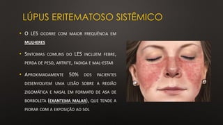 LÚPUS ERITEMATOSO SISTÊMICO
• O LES OCORRE COM MAIOR FREQUÊNCIA EM
MULHERES
• SINTOMAS COMUNS DO LES INCLUEM FEBRE,
PERDA DE PESO, ARTRITE, FADIGA E MAL-ESTAR
• APROXIMADAMENTE 50% DOS PACIENTES
DESENVOLVEM UMA LESÃO SOBRE A REGIÃO
ZIGOMÁTICA E NASAL EM FORMATO DE ASA DE
BORBOLETA (EXANTEMA MALAR), QUE TENDE A
PIORAR COM A EXPOSIÇÃO AO SOL
 