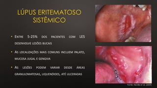 • ENTRE 5-25% DOS PACIENTES COM LES
DESENVOLVE LESÕES BUCAIS
• AS LOCALIZAÇÕES MAIS COMUNS INCLUEM PALATO,
MUCOSA JUGAL E GENGIVA
• AS LESÕES PODEM VARIAR DESDE ÁREAS
GRANULOMATOSAS, LIQUENÓIDES, ATÉ ULCERADAS
Fonte: Neville et al. (2009)
LÚPUS ERITEMATOSO
SISTÊMICO
 