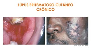 LÚPUS ERITEMATOSO CUTÂNEO
CRÔNICO
Fonte: Neville et al. (2009)
 