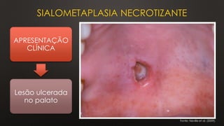 SIALOMETAPLASIA NECROTIZANTE
APRESENTAÇÃO
CLÍNICA
Lesão ulcerada
no palato
Fonte: Neville et al. (2009).
 