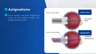 23
Público
Ocorre quando uma forma irregular da
córnea ou do cristalino produz uma
imagem borrada na retina
Visão normal
Astigmatismo
 