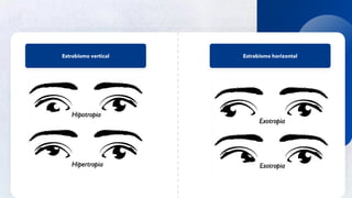 30
Público
Estrabismo vertical Estrabismo horizontal
 