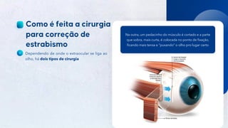 33
Público
Dependendo de onde o extraocular se liga ao
olho, há dois tipos de cirurgia
Na outra, um pedacinho do músculo é cortado e a parte
que sobra, mais curta, é colocada no ponto de fixação,
ficando mais tensa e “puxando” o olho pro lugar certo
 