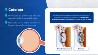 34
Público
Opacificação do cristalino do olho que
causa diminuição da capacidade visual
Pode afetar um ou ambos os olhos e é
frequente desenvolver-se lentamente
As cataratas são formadas por depósitos de proteínas ou
pigmentos amarelados no cristalino, que diminuem a
transmissão de luz para a retina na parte de trás do olho
Cristalino saudável Catarata
 