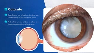 35
Público
Opacificação do cristalino do olho que
causa diminuição da capacidade visual
Pode afetar um ou ambos os olhos e é
frequente desenvolver-se lentamente
 