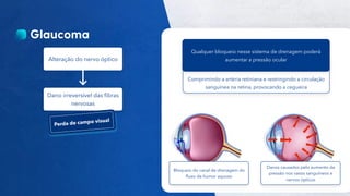 38
Público
Alteração do nervo óptico
Dano irreversível das fibras
nervosas
Comprimindo a artéria retiniana e restringindo a circulação
sanguínea na retina, provocando a cegueira
Qualquer bloqueio nesse sistema de drenagem poderá
aumentar a pressão ocular
Bloqueio do canal de drenagem do
fluxo de humor aquoso
Danos causados pelo aumento da
pressão nos vasos sanguíneos e
nervos ópticos
 