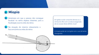 40
Público
Ametropia em que a pessoa não consegue
focalizar na retina objetos distantes, pois a
focalização ocorre antes da retina
Na situação de máximo relaxamento o
foco encontra-se antes da retina
A miopia pode ser corrigida com o uso de lentes
divergentes.
Um globo ocular comprido demais ou a
córnea do olho com curvatura exagerada
são as causas desse defeito visual
 
