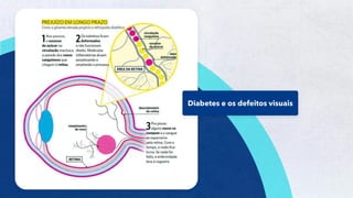 49
Diabetes e os defeitos visuais
 