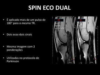 • É aplicado mais de um pulso de
180° para o mesmo TR.
• Dois ecos-dois sinais
• Mesma imagem com 2
ponderações
• Utilizadas no protocolo de
Parkinson
SPIN ECO DUAL
 