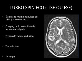 • É aplicado múltiplos pulsos de
180° para o mesmo tr.
• O espaço K é preenchido de
forma mais rápido.
• Tempo de exame reduzido.
• Trem de eco
• TR longo
TURBO SPIN ECO ( TSE OU FSE)
 