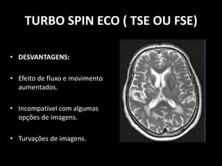 • DESVANTAGENS:
• Efeito de fluxo e movimento
aumentados.
• Incompatível com algumas
opções de imagens.
• Turvações de imagens.
TURBO SPIN ECO ( TSE OU FSE)
 