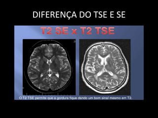 DIFERENÇA DO TSE E SE
 
