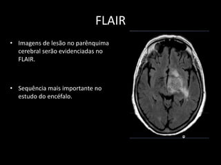 • Imagens de lesão no parênquima
cerebral serão evidenciadas no
FLAIR.
• Sequência mais importante no
estudo do encéfalo.
FLAIR
 