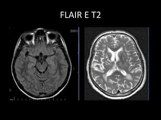 FLAIR E T2
 