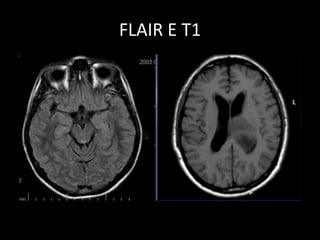 FLAIR E T1
 