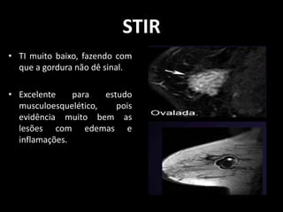 • TI muito baixo, fazendo com
que a gordura não dê sinal.
• Excelente para estudo
musculoesquelético, pois
evidência muito bem as
lesões com edemas e
inflamações.
STIR
 