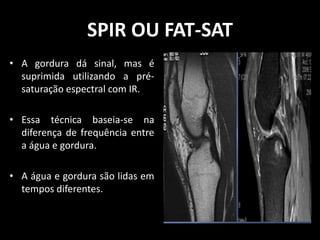 • A gordura dá sinal, mas é
suprimida utilizando a pré-
saturação espectral com IR.
• Essa técnica baseia-se na
diferença de frequência entre
a água e gordura.
• A água e gordura são lidas em
tempos diferentes.
SPIR OU FAT-SAT
 