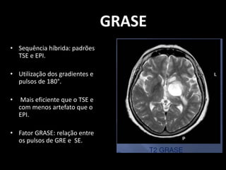 • Sequência híbrida: padrões
TSE e EPI.
• Utilização dos gradientes e
pulsos de 180°.
• Mais eficiente que o TSE e
com menos artefato que o
EPI.
• Fator GRASE: relação entre
os pulsos de GRE e SE.
GRASE
 