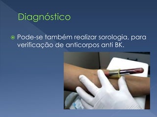  Pode-se também realizar sorologia, para
verificação de anticorpos anti BK.
 